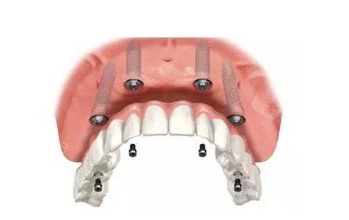 宁波种植牙去哪家医院比较好？年终盘点后推荐宁波恒美