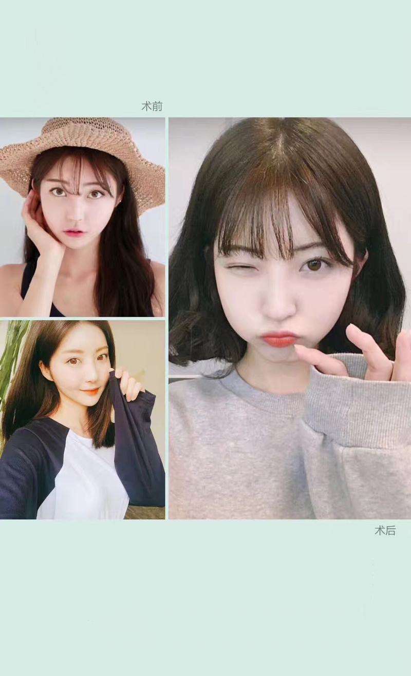 大理韩美医疗美容眼部整形收费价目表，眼皮下垂矫正：
