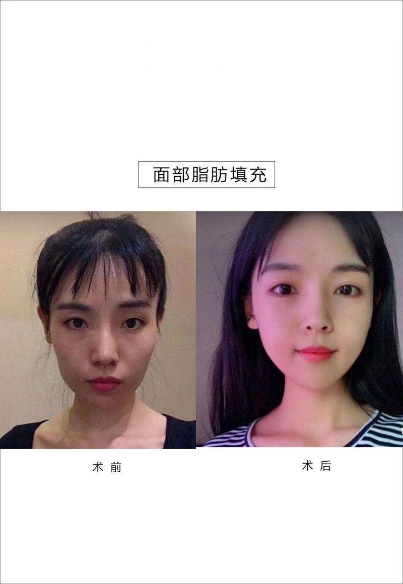 大理眼部整形收费价格表，眼皮下垂矫正：2845\眼