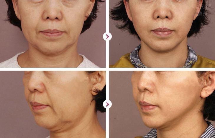 南昌抗衰除皱哪家医院效果好？推荐：佳美、韩美、东方