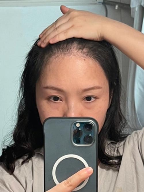 北京改善发际线高医生排名口碑测评！武春燕、徐霞、孙