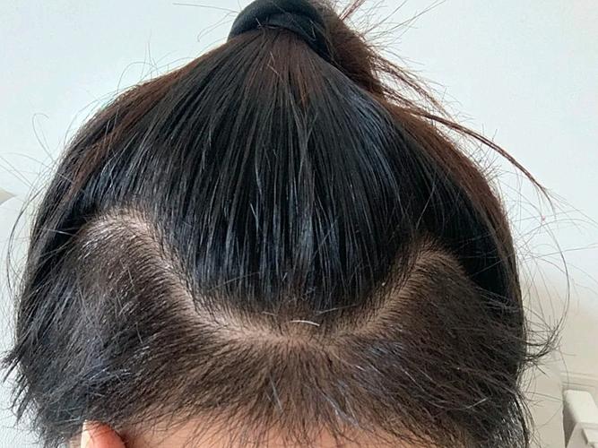 长沙改善发际线高哪些医院好？这五家实力机构值得了解