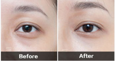 宝鸡祛泪沟好的医院有哪些？这几家技术实力获承认