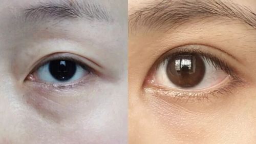 广州做自体脂肪祛泪沟哪些医院靠谱？这几家机构技术口