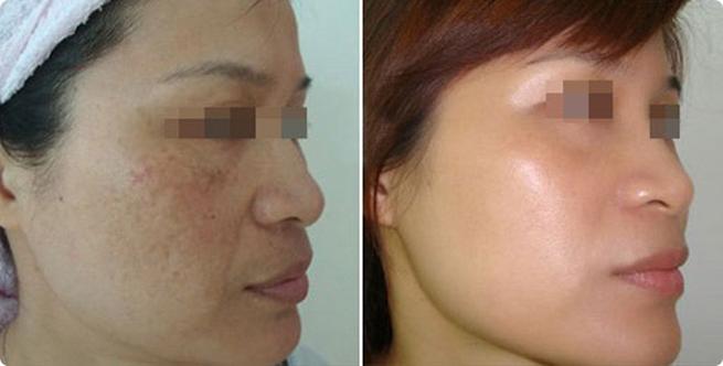 怀化激光祛斑哪家医院效果好？5家专业正规医疗机构深