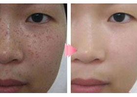 南京祛斑医生排名新鲜出炉，专业祛斑医生名单大公开