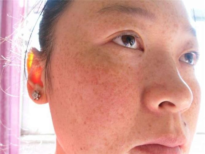 长沙祛斑医院哪家技术强？美莱、雅美、湘雅二院等专业