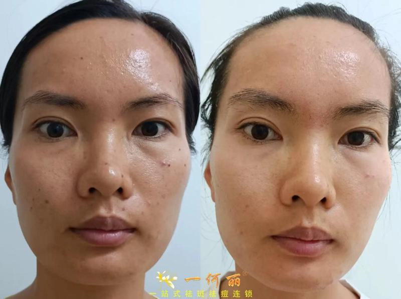 宁波激光祛斑医院排名榜单公布，专业机构详情解析