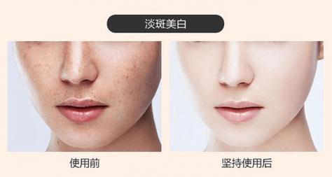 温州激光祛斑哪家医院技术更专业？韩星-星美真实口碑