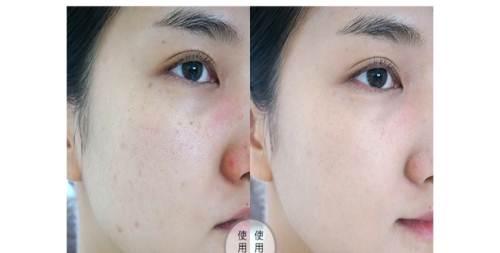 威海华怡医疗美容医院激光美容技术怎么样？2025年