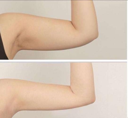 全身吸脂手术有哪些注意事项长沙健丽医疗美容专业定制