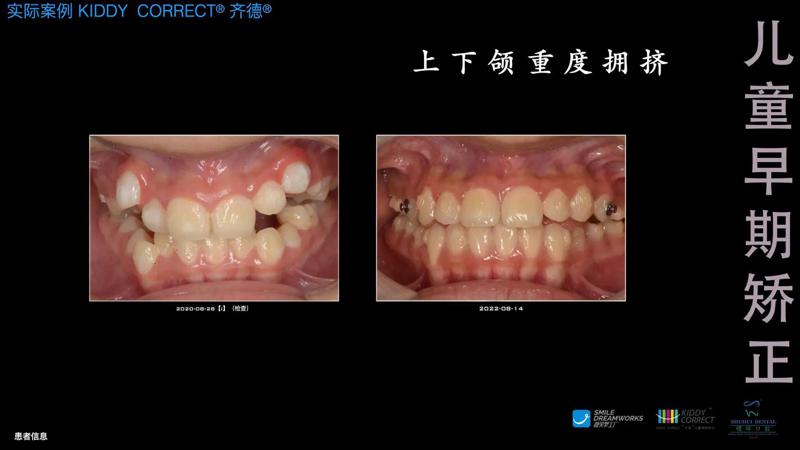 佛山牙齿矫正哪家医院好？佛山第二人民医院、顺德医院
