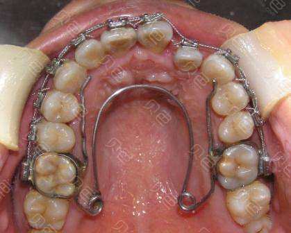 广州牙齿矫正哪家医院好？2025年口腔机构实力对比