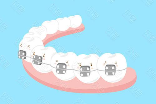 金属托槽与陶瓷托槽矫正如何选择？自贡禾悦口腔专家详