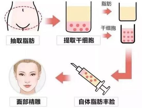 郑州颐和医院自体脂肪隆胸费用、医生团队及价格表全解