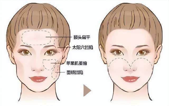 佛山第二人民医院自体脂肪填充医生哪个好？真实案例反