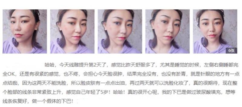 沈阳脂肪填充哪家医院好？这五家技术精湛口碑佳，值得