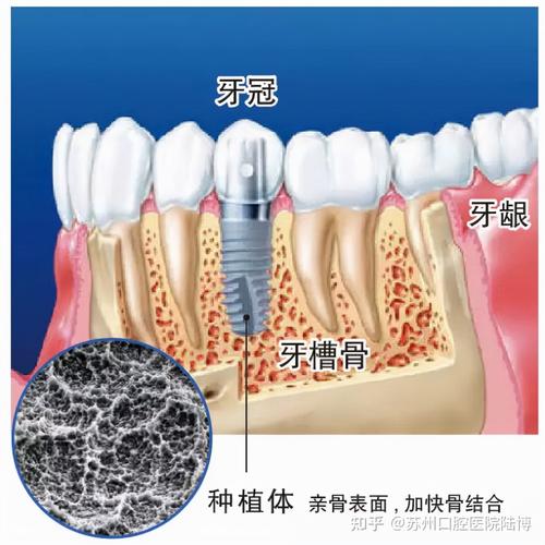 重庆八益牙科种植牙技术怎么样？专业团队+先进设备+