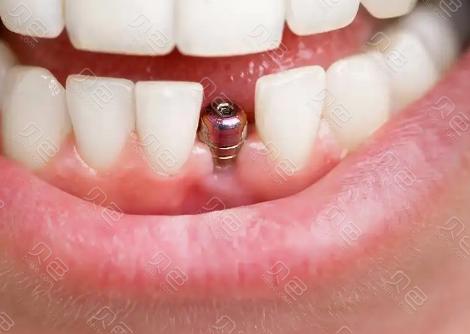 台州公立医院口腔整形排名揭晓！前三强技术对比！种植