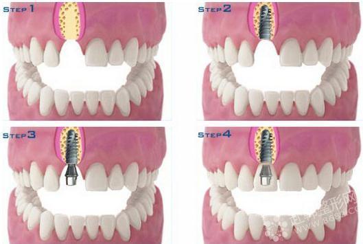 牙齿种植术后护理指南：苏州金阊医院专家提醒五大注意