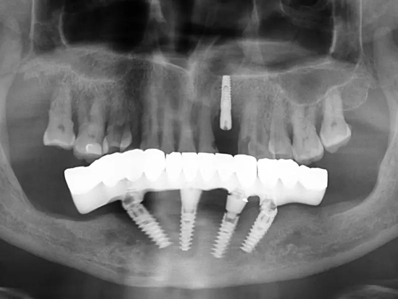 重庆美连口腔当天种牙当天用真实可行吗？即刻种植技术