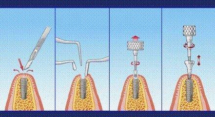 2025郑州种植牙价格一览表：单颗-全口费用解析及