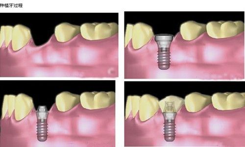 贵阳君雅京恬口腔种牙贵吗，单颗种植牙6704元至1