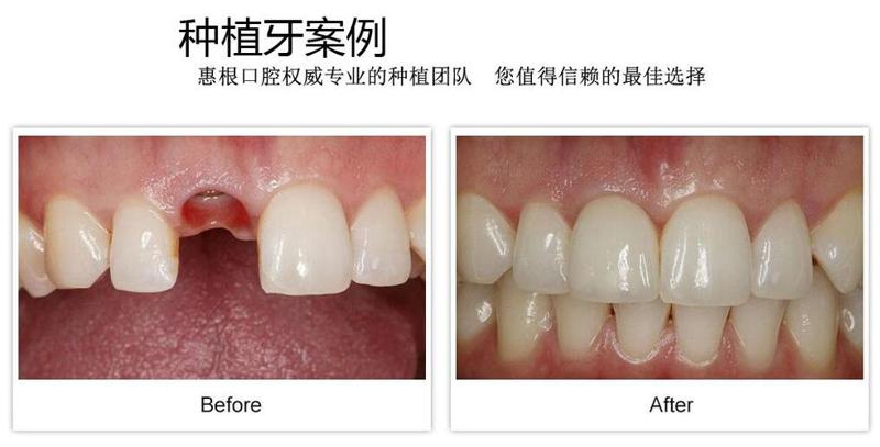 连云港江南口腔怎么样？海州区推荐：江南口腔专业种植