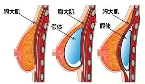 乌鲁木齐隆胸修复医生哪家强？华美整形等6大医院专家