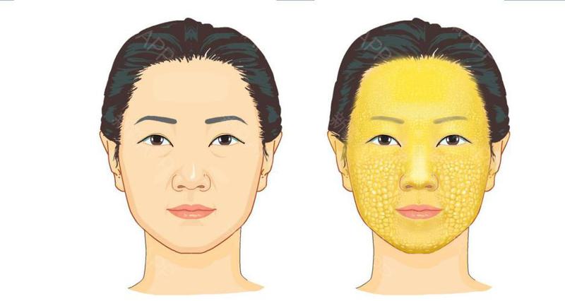 昆明自体脂肪丰卧蚕医院排名前五，实力医生与价格明细