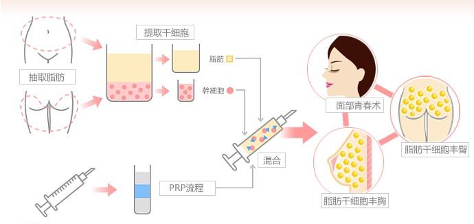 宁波自体脂肪丰鼻基底哪家医院好？五家优质机构技术特