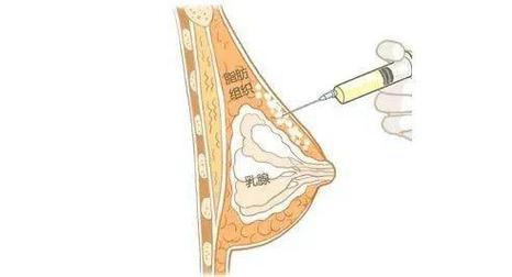 太原自体脂肪丰鼻基底哪家医院好？5家技术精湛机构实
