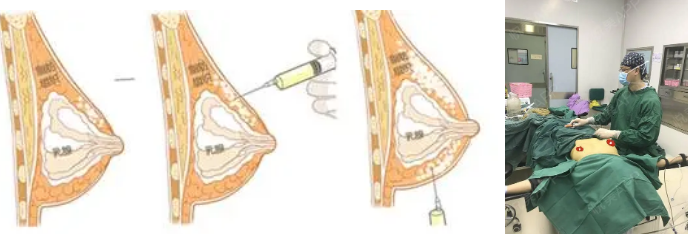 昆明自体脂肪填充哪家医院好？5家口碑医院深度解析！