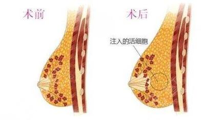 温州做自体脂肪隆胸好的医院有哪些？5家实力机构专业