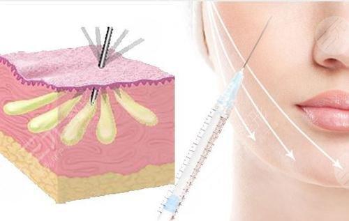 宁波自体脂肪填充哪家医院好？这五家专业机构口碑与技